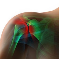 Lysis of adhesions in shoulder