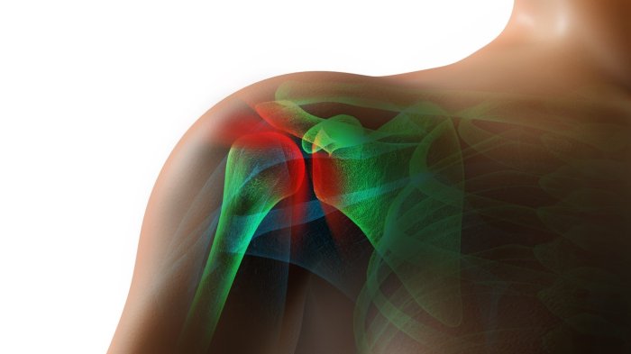 Lysis of adhesions in shoulder