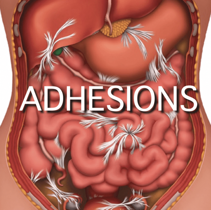 Lysis adhesions laparoscopic