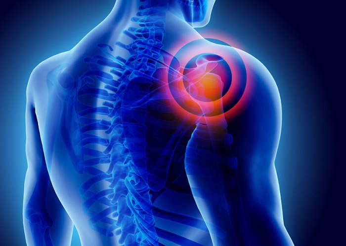 Lysis of adhesions in shoulder